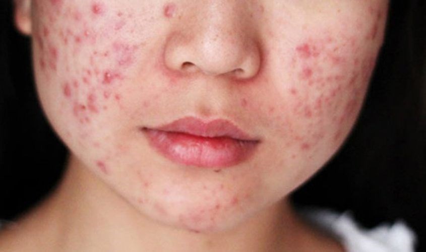 Không dùng kem dưỡng ẩm La Roche Poáy khi đang bị mụn nghiêm trọng