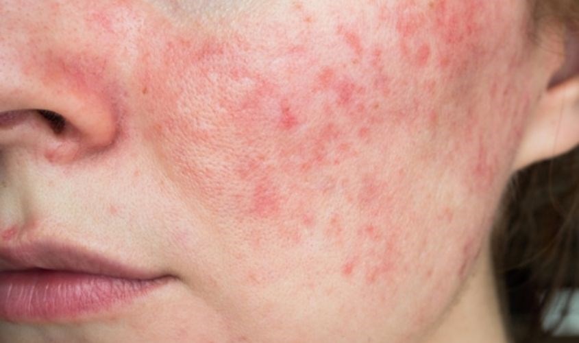 Kích ứng với một số thành phần có trong sản phẩm