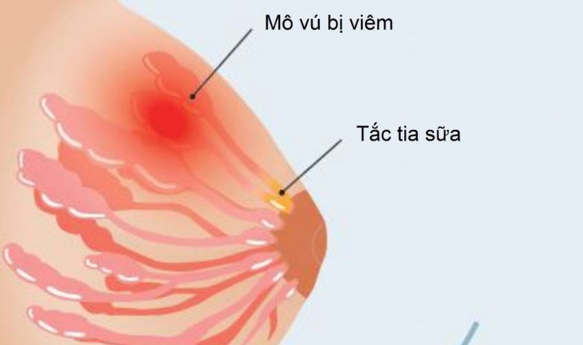 Nhiễm khuẩn gây ra viêm tuyến vú