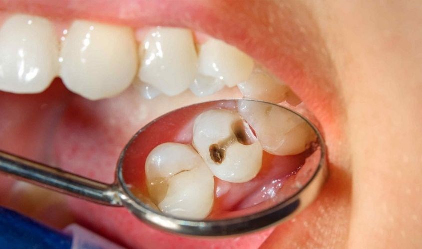 Bé không được vệ sinh răng miệng sạch sẽ và đúng cách có thể bị sâu răng Bé không được vệ sinh răng miệng sạch sẽ và đúng cách có thể bị sâu răng