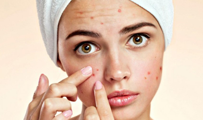 Phân biệt đẩy mụn và nổi mụn thông thường