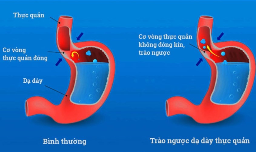 Nguyên nhân trào ngược dạ dày do thực quản