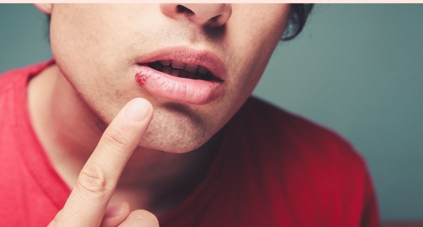 Lysine giúp điều trị vết loét lạnh