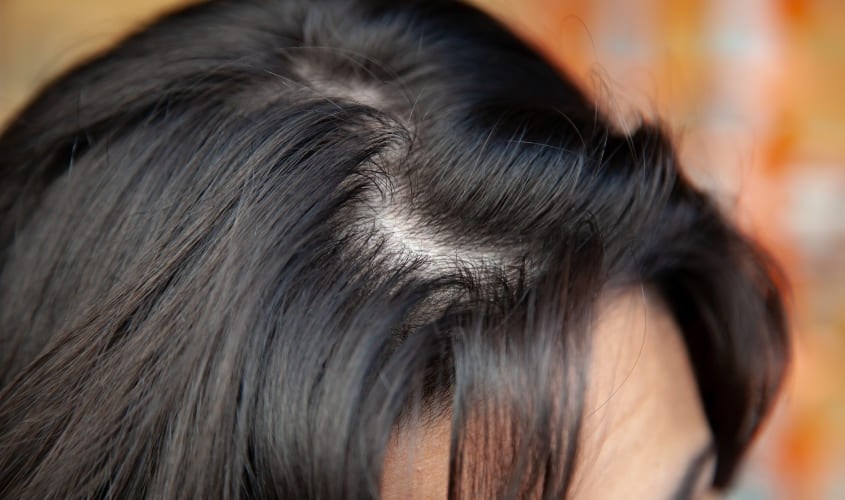 Tóc mỏng có các sợi tóc mọc cách xa nhau và thấy rõ phần da đầu