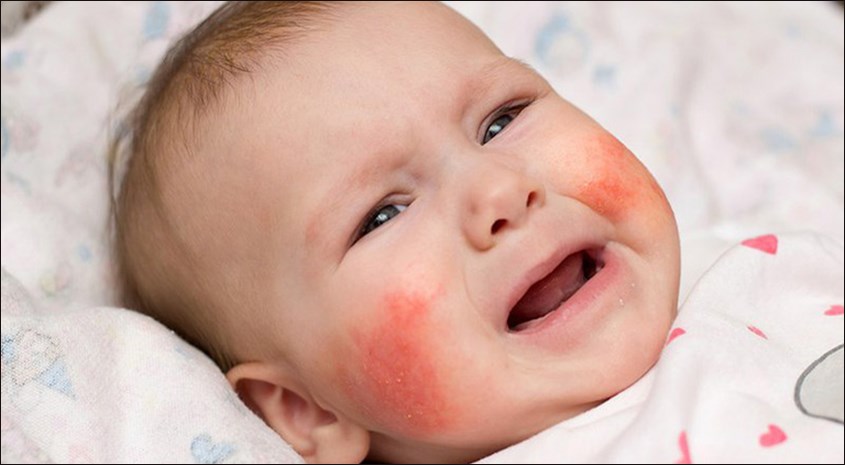 Viêm da dị ứng ở trẻ em là bệnh gì?