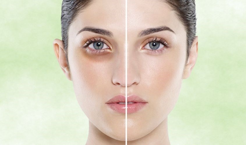 Giảm thâm mắt hiệu quả