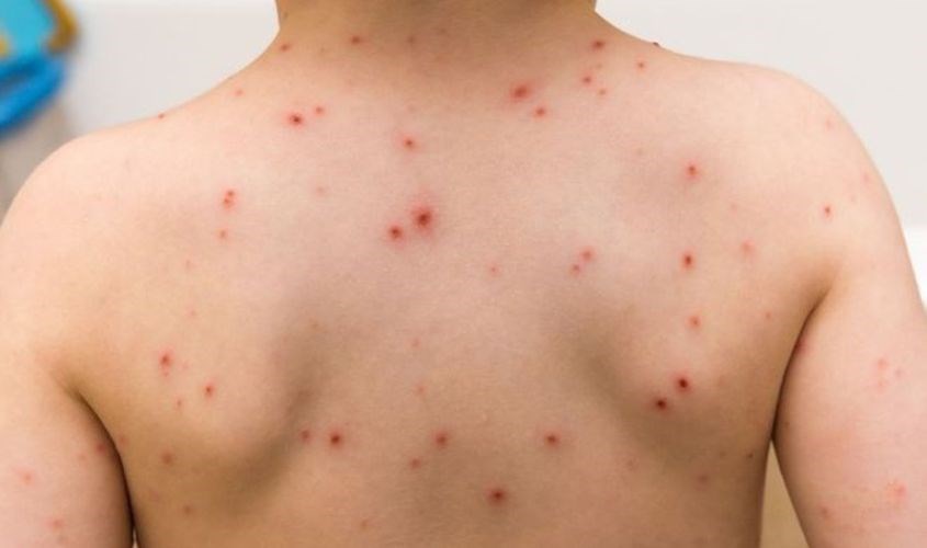 Trẻ em mắc bệnh sởi. Nguồn: Internet Trẻ em mắc bệnh sởi. Nguồn: Internet