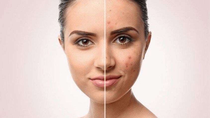 Retinol có công dụng trị mụn