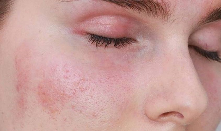 Da treatment sử dụng các hoạt chất hóa học mạnh để điều trị chuyên sâu