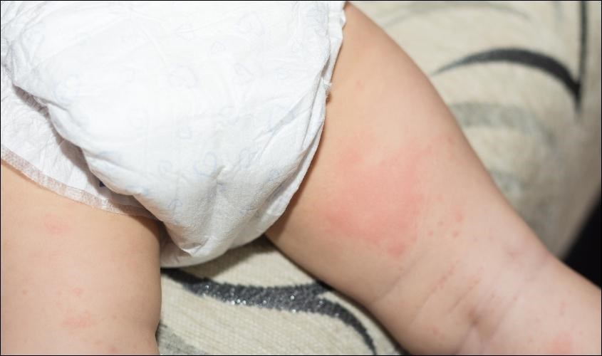 Tình trạng hăm tã ở trẻ sơ sinh xuất hiện nhiều vào mua hè nóng ẩm