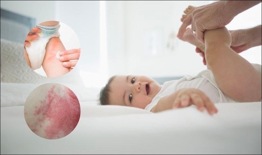 Vùng da tiếp xúc với tã như các ngấn ở đùi, mông, bẹn,... xuất hiện mẩn đỏ, gây đau