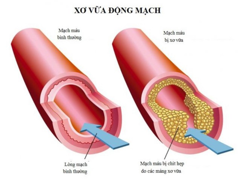 Hàm lượng cholesterol cao gây xơ vữa động mạch