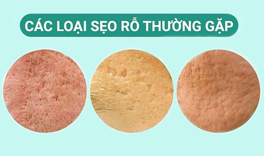 Cấu trúc elastin bị phá vỡ sẽ tạo thành sẹo trên da Cấu trúc elastin bị phá vỡ sẽ tạo thành sẹo trên da