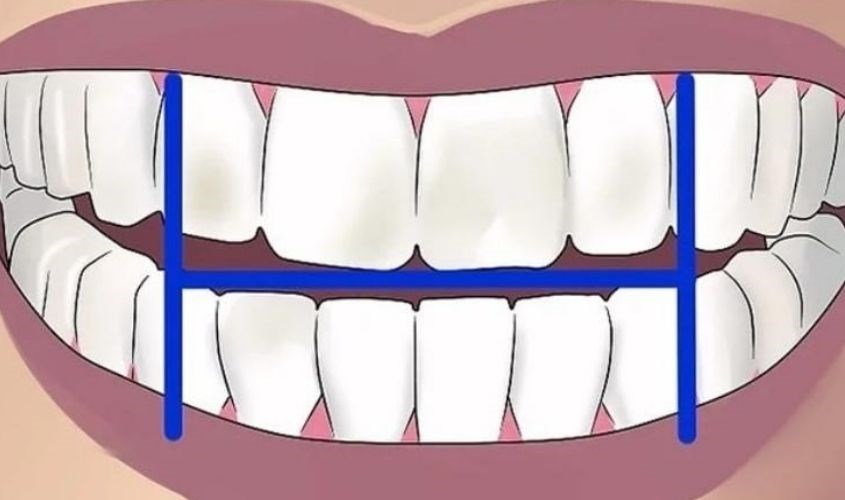 Chia răng thàng góc phần tư và chải theo thứ tự