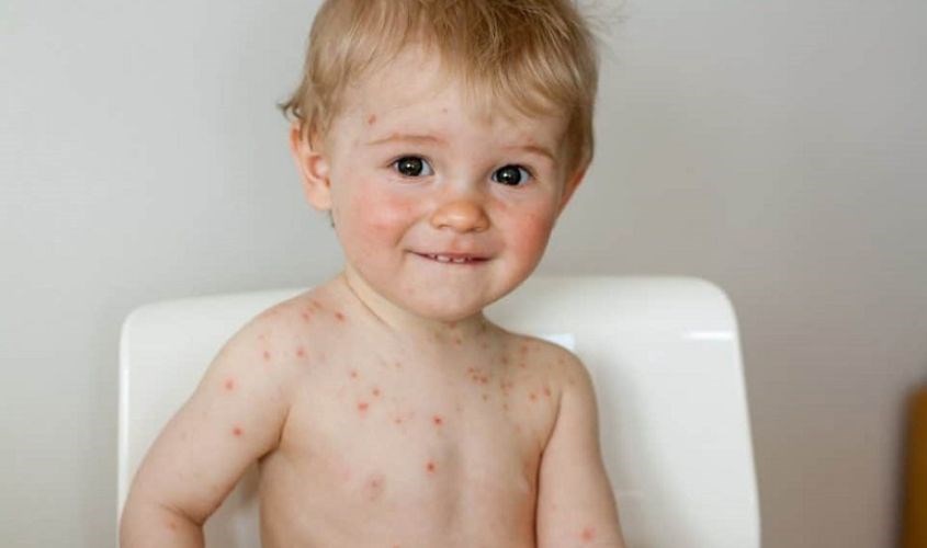 Trẻ ăn rong biển có thể bị dị ứng