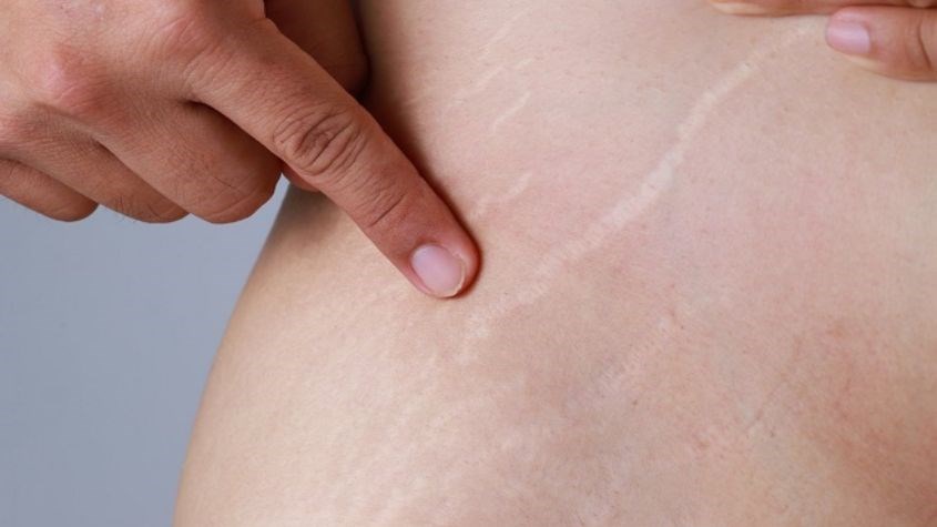 Rạn da ở vùng bụng 