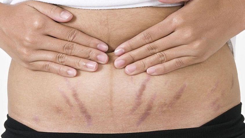 Biểu hiện của tình trạng rạn da sau sinh