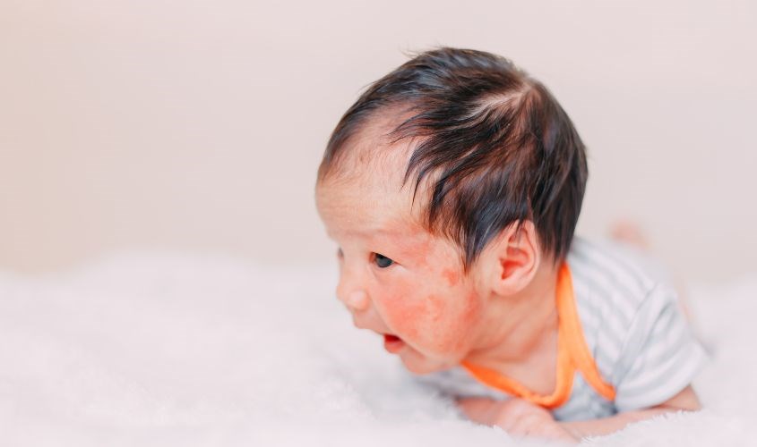 Rôm sảy tuy khiến da bé bị nổi hạt sần sùi ngứa ngáy khó chịu nhưng lại lành tính. Nguồn: Canva Rôm sảy tuy khiến da bé bị nổi hạt sần sùi ngứa ngáy khó chịu nhưng lại lành tính.