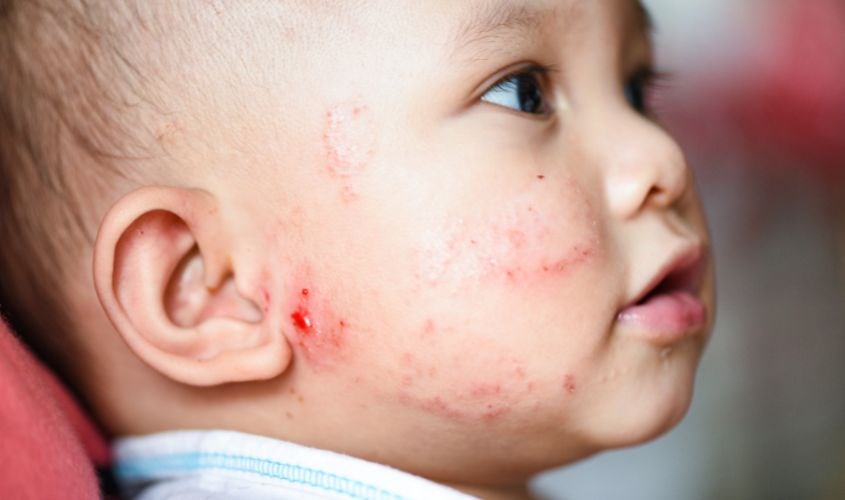 Viêm da cơ địa khiến da bé bị nổi hột sần sùi, gây sưng phù và ngứa. Nguồn: Canva Viêm da cơ địa khiến da bé bị nổi hột sần sùi, gây sưng phù và ngứa.
