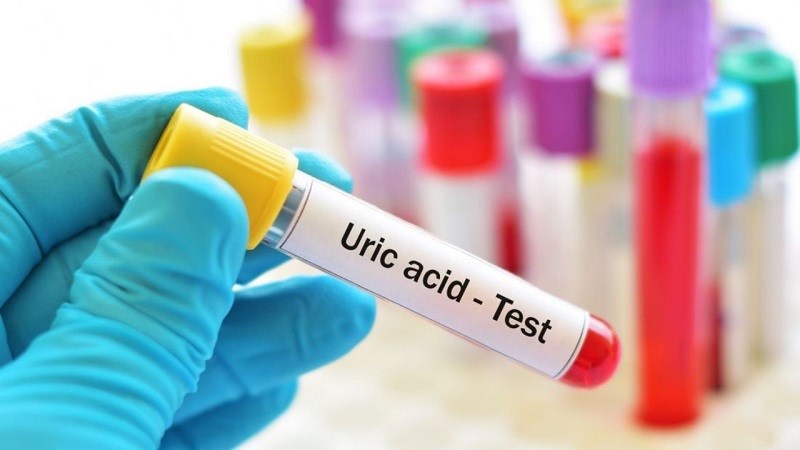 Xét nghiệm máu cho kết quả tăng acid uric là một gợi ý chẩn đoán bệnh