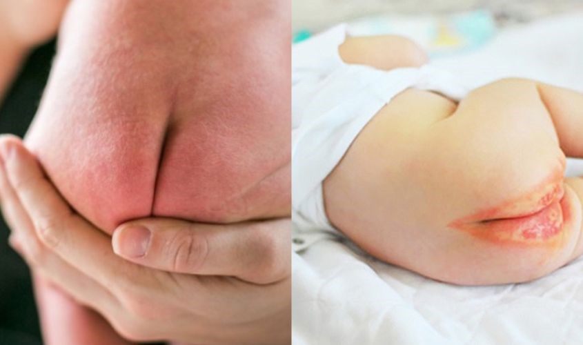 Bé bị hăm do không đúng size bỉm | Tã bỉm Bonbaby, Bỉm Bondbaby UK, Bỉm Bonbaby Cá Heo