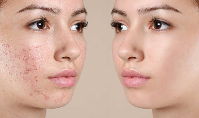 Tẩy tế bào chết giúp làm sạch bã nhờn, bụi bẩn, cải thiện tình trạng mụn