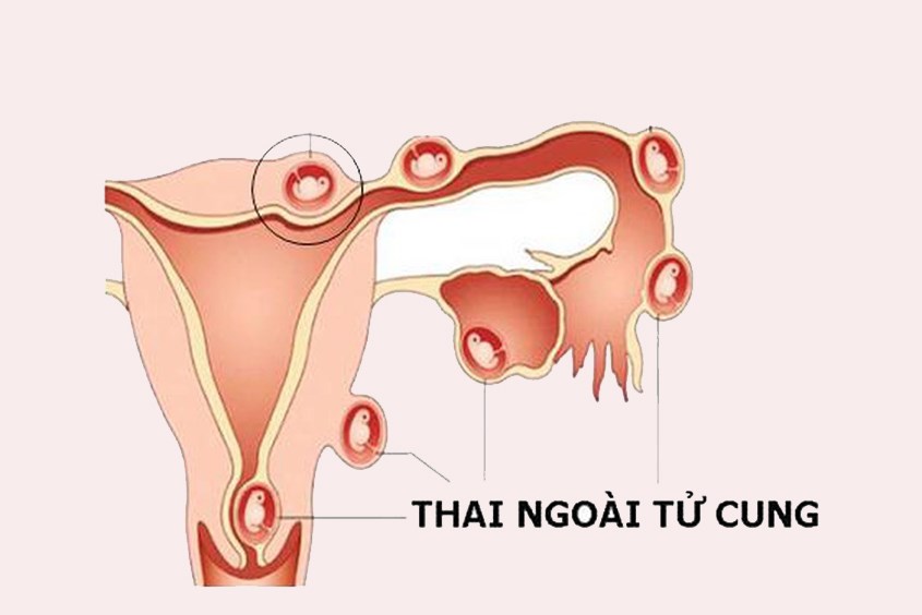 Thai có thể làm tổ tại nhiều vị trí khác nhau ngoài tử cung