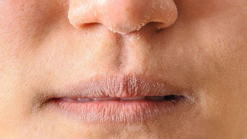 Da, môi khô là dấu hiệu của mất nước khi có tiêu chảy và nôn mửa nhiều