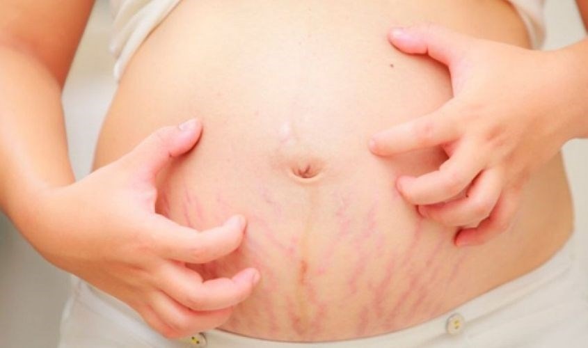 Ngứa rát, mẩn đỏ do sử dụng Niacinamide với nồng độ cao