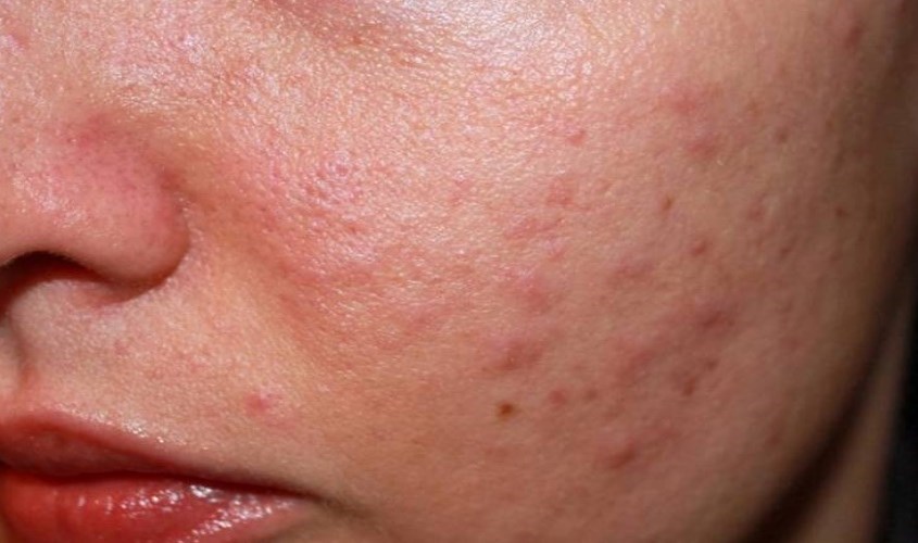 AHA rất dễ gây kích ứng cho làn da nhạy cảm của mẹ bầu nếu sử dụng sai cách