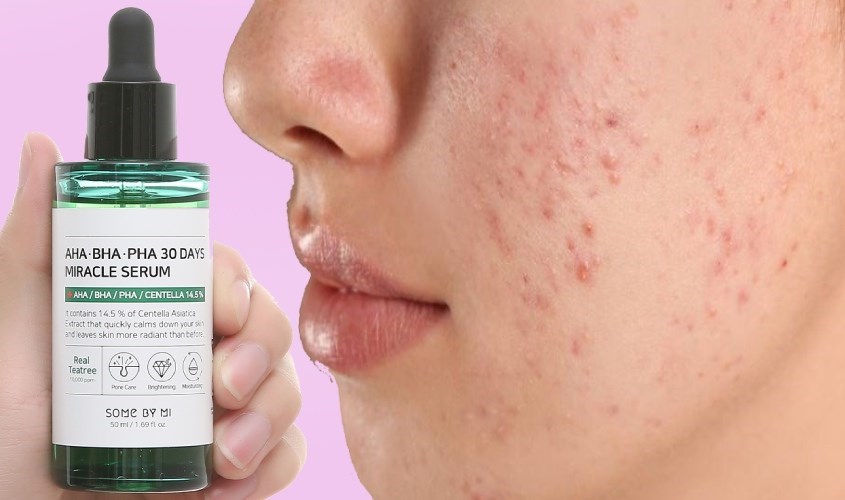 Tinh chất kháng khuẩn giảm mụn Some By Mi AHA-BHA-PHA 30 Days Miracle 50 ml hỗ trợ điều trị mụn