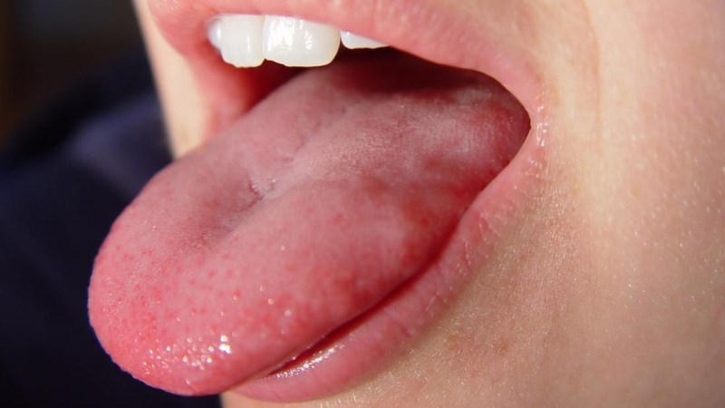 Sưng lưỡi là bệnh gì? Nguyên nhân gây và biến chứng của sưng lưỡi