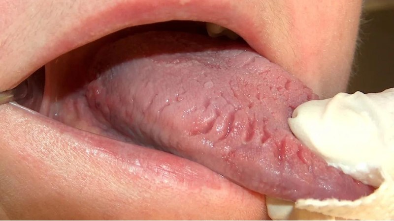 Các dấu hiệu của bệnh sưng lưỡi