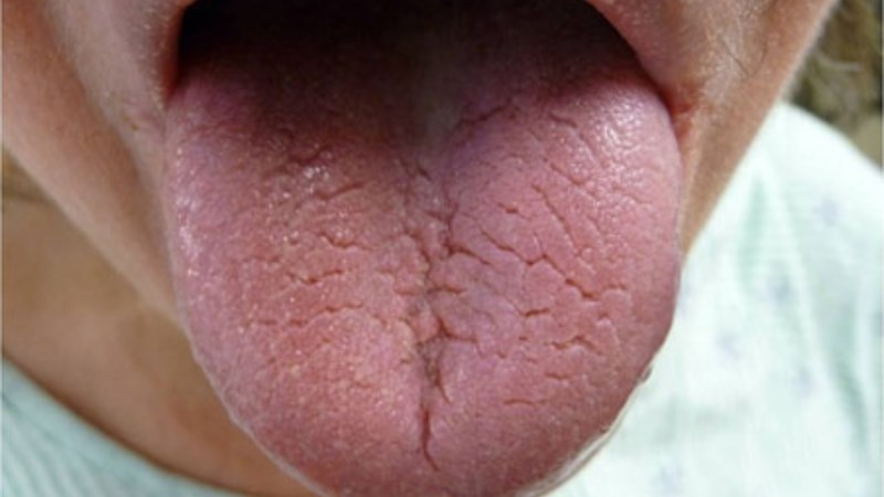Nguyên nhân gây ra sưng lưỡi