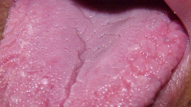 Nguyên nhân gây ra sưng lưỡi