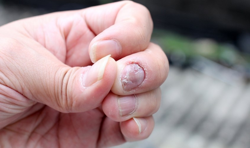 Hỗ trợ khắc phục nấm móng tay