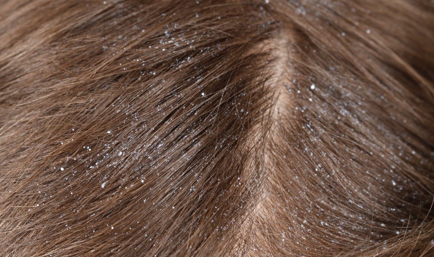 Hỗ trợ trị gàu cho bé