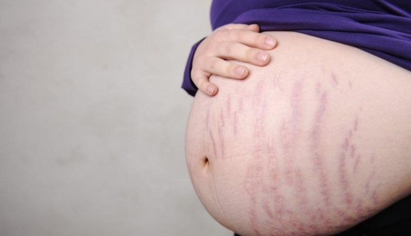 Rạn da xuất hiện do thay đổi nội tiết tố trong quá trình mang thai