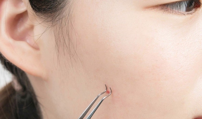 Sử dụng nhíp gấp nhân mụn Sử dụng nhíp gấp nhân mụn