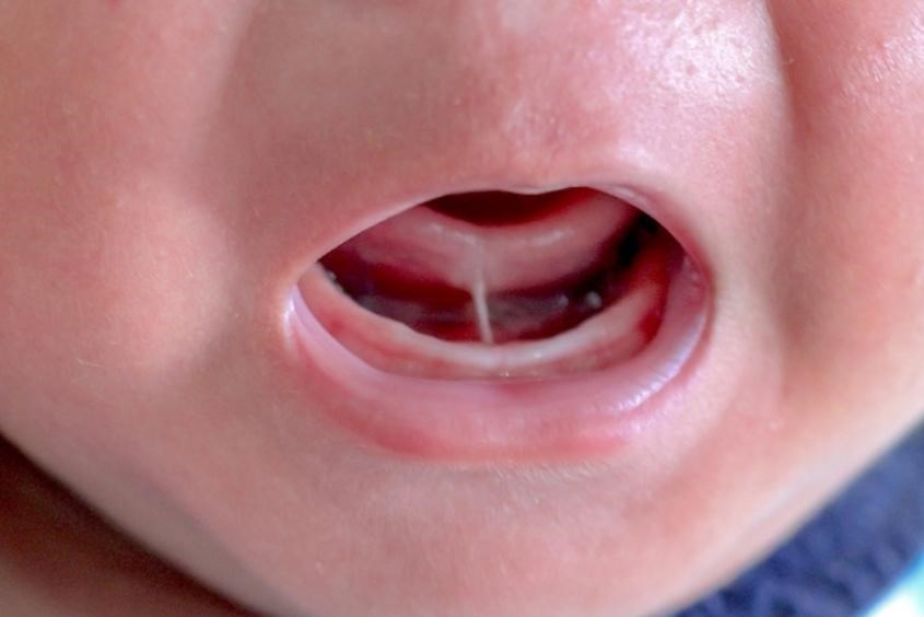 Các mức độ dính thắng lưỡi ở trẻ