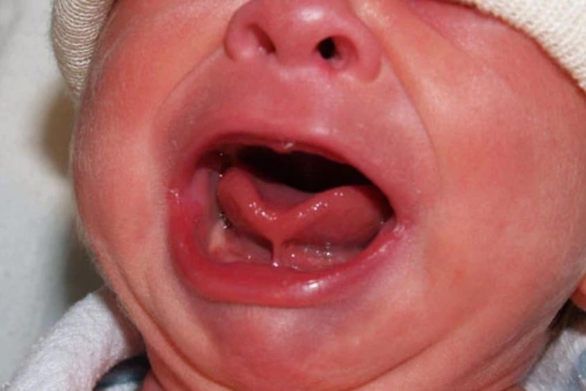 Dính thắng lưỡi ở trẻ có tự hết không