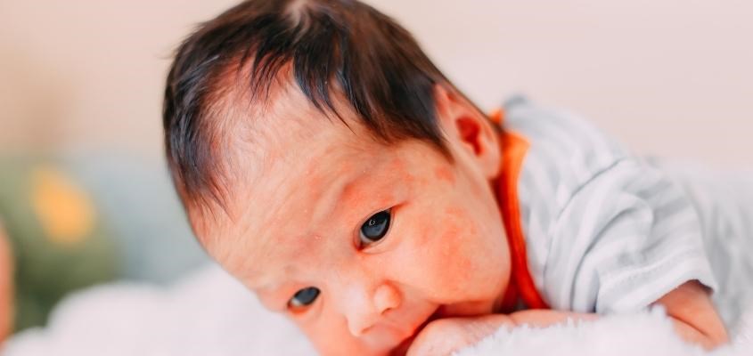 Triệu chứng mẫn đỏ khi bé bị dị ứng