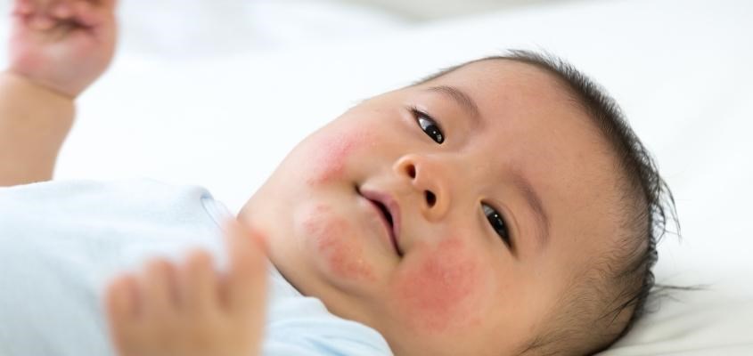 Trẻ nổi mẩn đỏ khi bị dị ứng đạm sữa bò