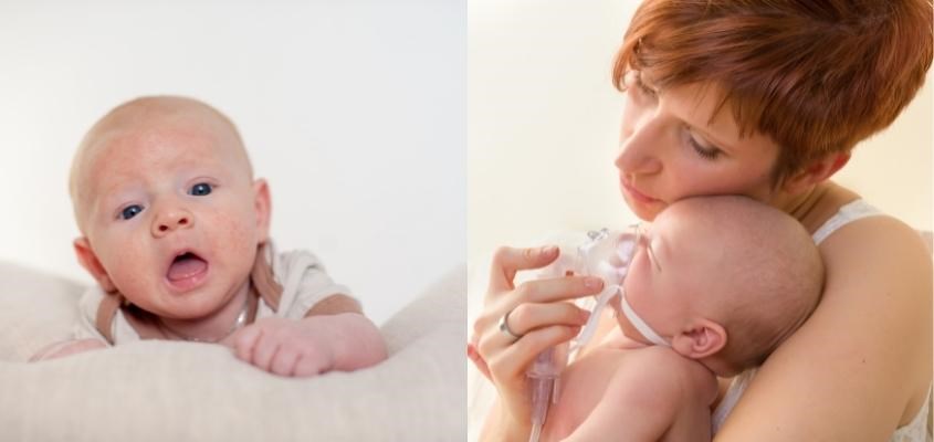 Bất dung nạp lactose ở trẻ sơ sinh thường bắt đầu trong giai đoạn đầu sau khi bé chào đời