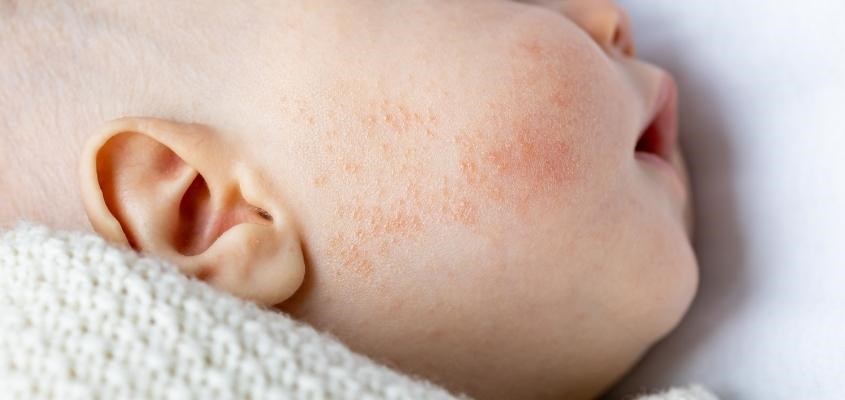 Ngay khi có những triệu chứng, bác sĩ sẽ kiểm tra cơ thể bé