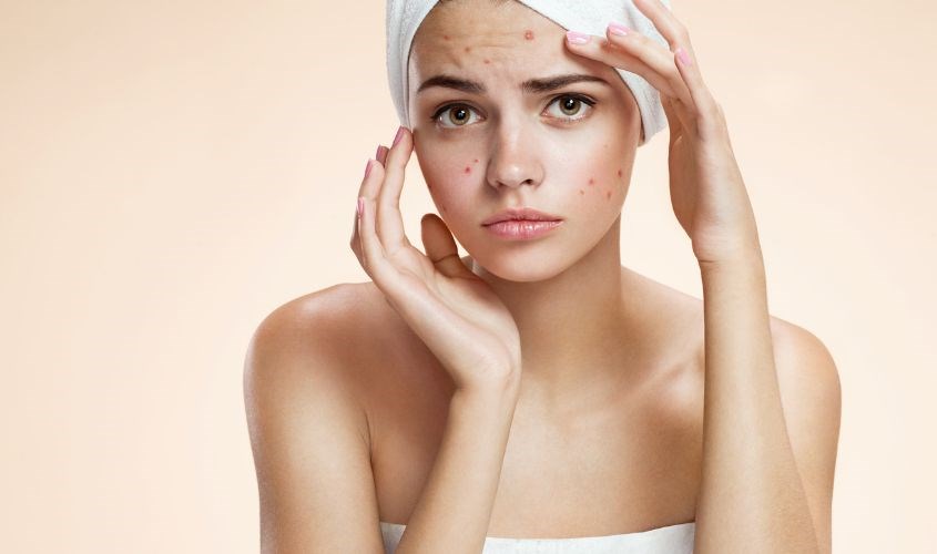 Dùng tinh bột nghệ hết hạn đắp mặt sẽ gây mụn, dị ứng. 