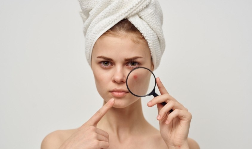 Lạm dụng xông mặt khiến da có mụn