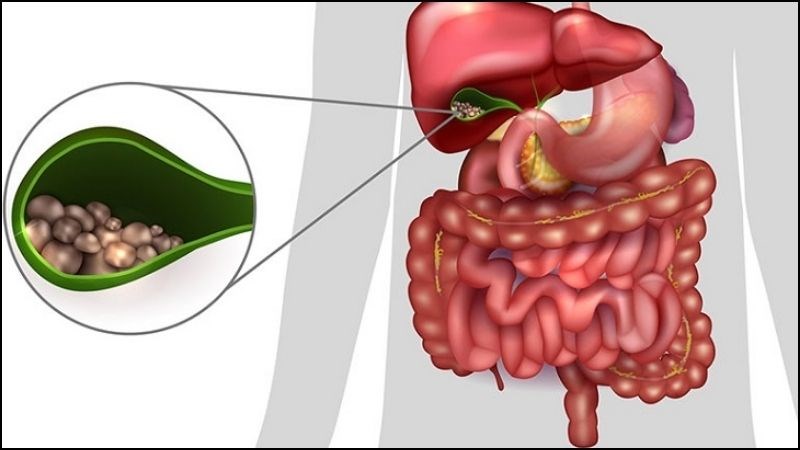 Bệnh sỏi mật nên kiêng gì và ăn gì để giúp tan sỏi? Lưu ý trong chế độ dinh dưỡng