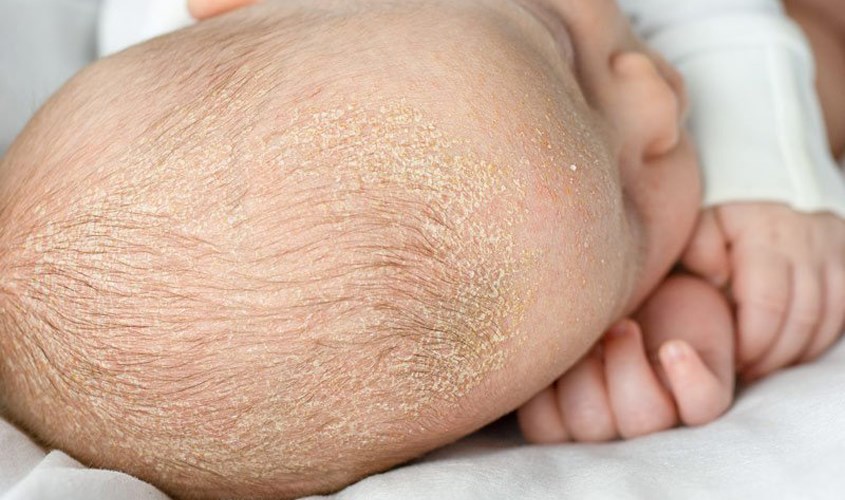 Lớp vảy trên da đầu con là biểu hiện của bệnh viêm da tiết bã