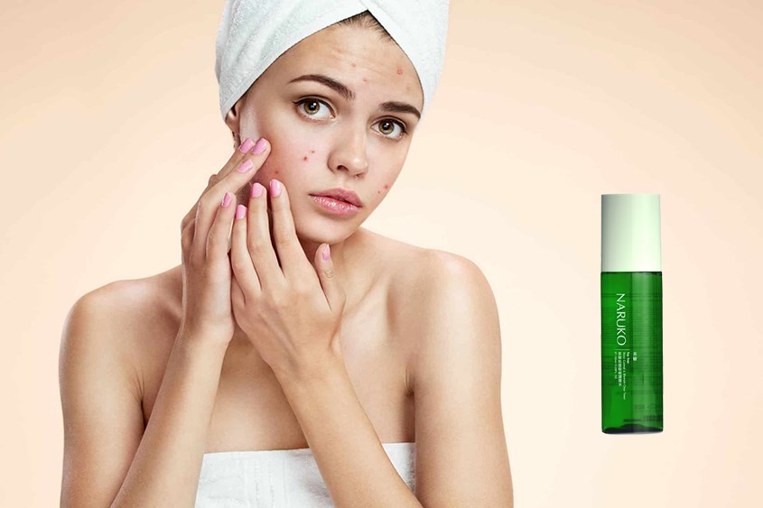 Toner Naruko có chứa BHA không nên sử dụng sau khi nặn mụn